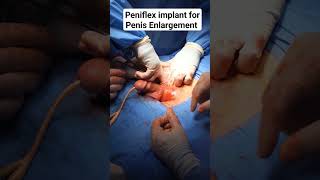 Download lagu Peniflex implant for Penis Enlargement surgery by Dr Araz Bayramov #andrologist #penileenlargement mp3 Download lagu Peniflex implant for Penis Enlargement surgery by Dr Araz Bayramov #andrologist #penileenlargement mp3