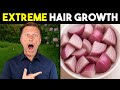 Onion Juice For Extreme Hair Growth Stop Hair Loss