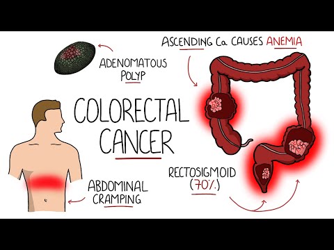 Acute Pancreatitis Causes Signs Symptoms Pathophysiology Diagnosis