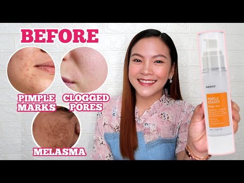 QUICKFX PIMPLE ERASER WATER GEL review | For MELASMA, PIMPLE MARKS and CLOGGED PORES