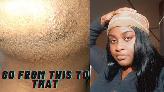 REMOVE INGROWNS HAIR ON CHIN WITH ME  episode 3