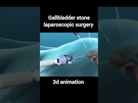 gallbladder stone removal laparoscopic surgery #shorts #humanbody #medical #3d #biology #surgery