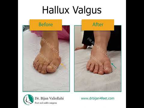 Hallux valgus