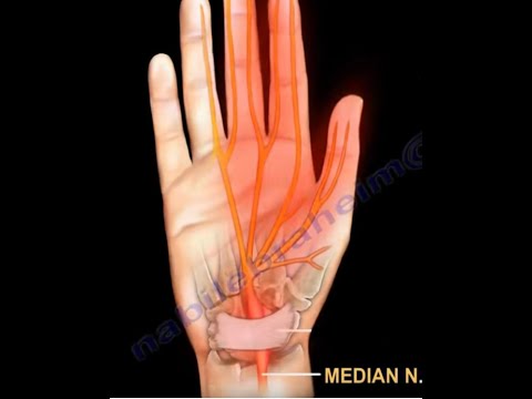 Patient Self Diagnose Carpal Tunnel Syndrome