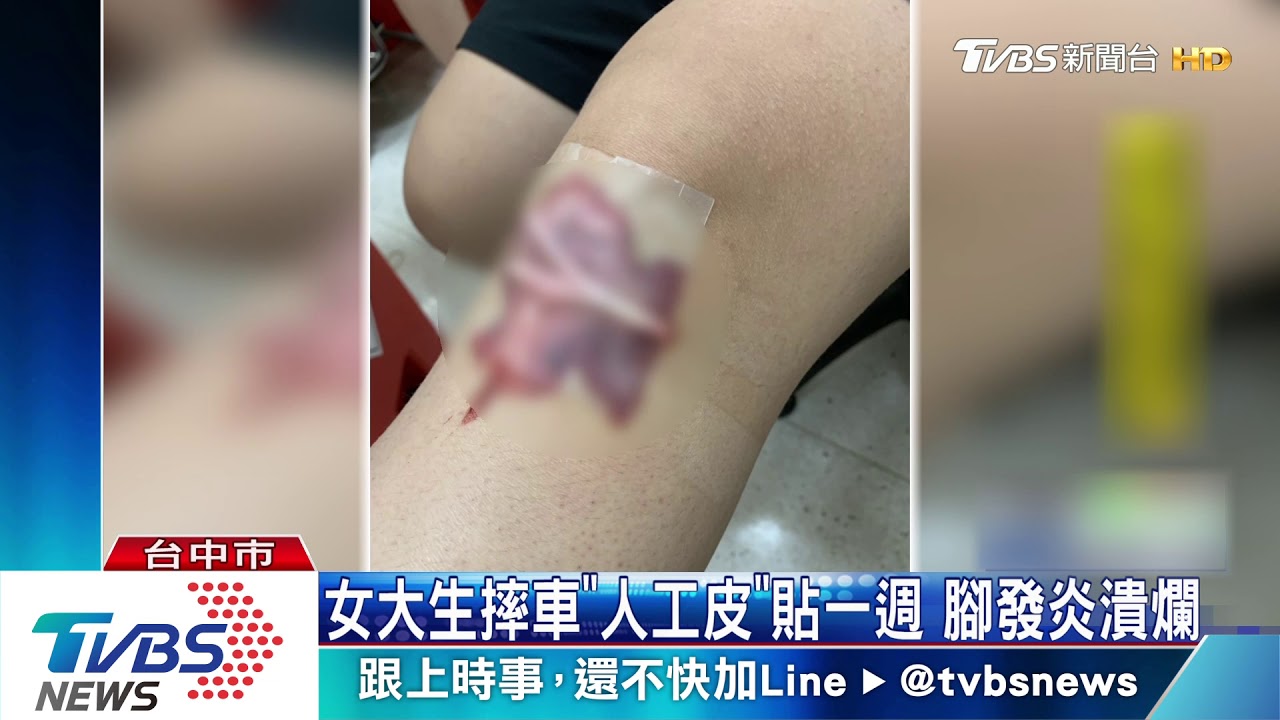 女大生摔車「人工皮」貼一週　腳發炎潰爛