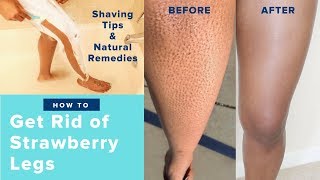 How to Get Rid of Strawberry Legs Fast LIKE A BOSS! | Easy Regimen & AT HOME REMEDIES