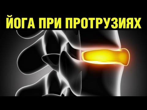 Остеохондроз с3 с4 Ушиб голеностопного сустава лечение отека