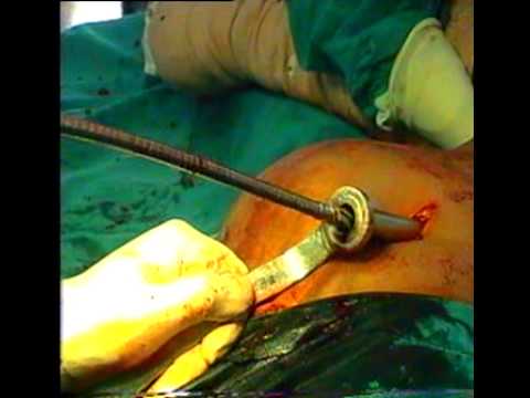 Femur Nailing in Lateral Position - OrthoTV
