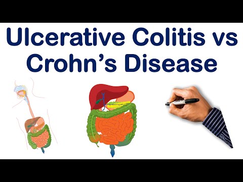 Ulcerative Colitis vs Crohn's Disease Part 1| STEP NCLEX COMLEX