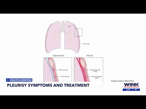 Symptoms and treatment for pleurisy, the inflammation of lungs’ lining