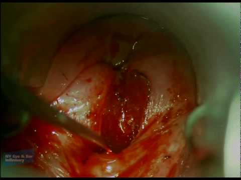 Endoscopic Cricopharyngeal Myotomy