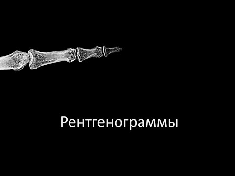 Грыжа межпозвонковых дисков пояснично-крестцового отдела Народные методы в лечении артроза коленных суставов