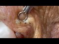Blackhead Removal Satisfying Routine 118