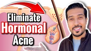 How to Get RID of Hormonal Acne | 5 Ways to Treat Hormonal Acne