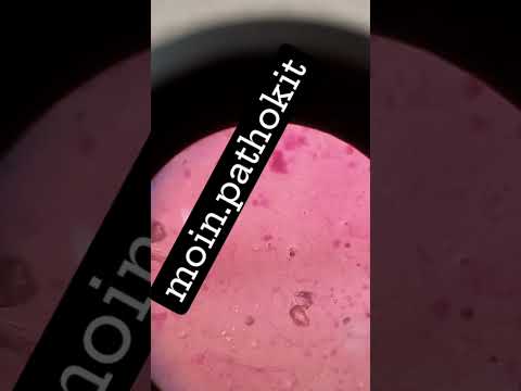 tuberculosis bacteria 🦠 in microscope#moin.pathokit #Tb#slid#staning#medicine#treatment#medical.vide