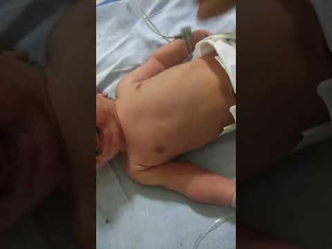A Breech Vaginal Delivered Baby With Birth Asphyxia