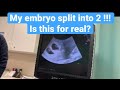 My embryo split into 2 !!! Is this for real? #short