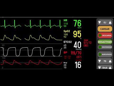 SECUENCIA DE RITMO SINUDAL A FIBRILACION Y DESFIBRILACION EN CURVAS DE MONITOR