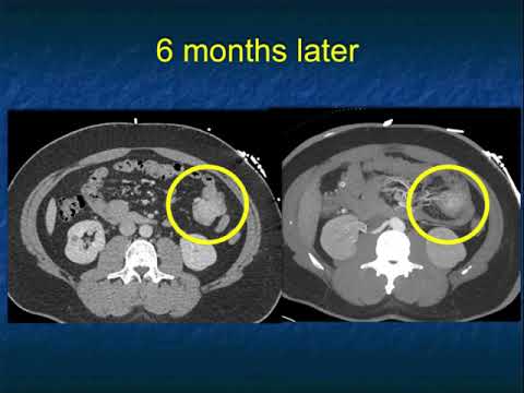 CT Evaluation of Small Bowel Tumors: Detection & Classification - Part 1