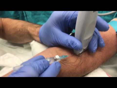 Ultrasound Guided Peripheral IV Insertion - "In-plane" Approach