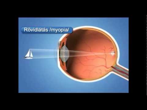 Egyszerű látás-helyreállítási módszer