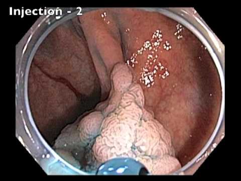 Ileocecal Valve: Flat Lesion - Injections