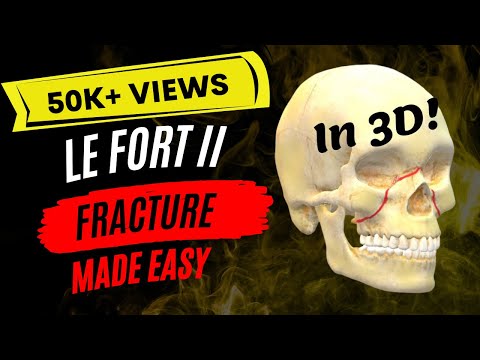 ORAL SURGERY | Le Fort II Fracture in 3D