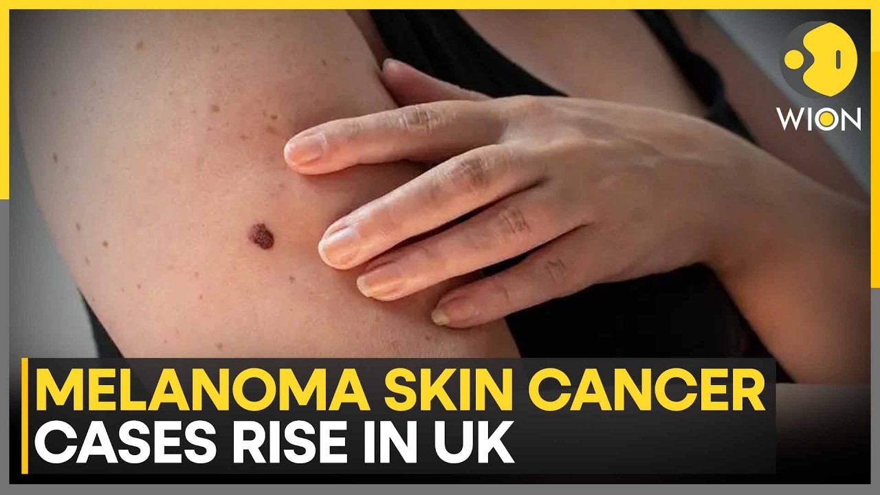 Melanoma Skin Cancer Cases Hit Record Level in UK | WION News