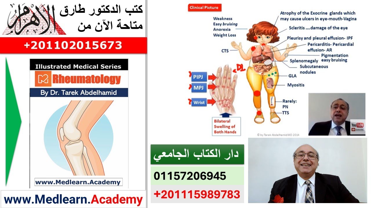 Rheumatoid Arthritis (RA)  #cme #internal_medicine  #usmle #medicalschool   #medical #محاضرات_باطنة