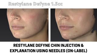 Restylane Defyne Chin Injection & Explanation Using Needles (On-Label) - Steven F. Weiner, MD