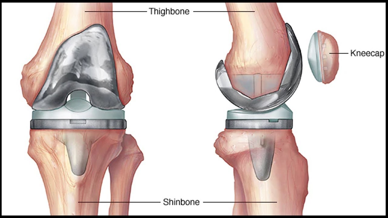 साई अस्पताल घुटने की सर्जरी | Knee Replacement Treatment | घुटने के प्रतिस्थापन उपचार