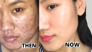 How to Get Rid of Acne Scars & Hyperpigmentation | Post-Hormonal Acne Scars |