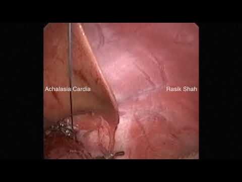 Esophago-cardiomyotomy with anterior Dor Fundoplication by Dr. Rasik Shah