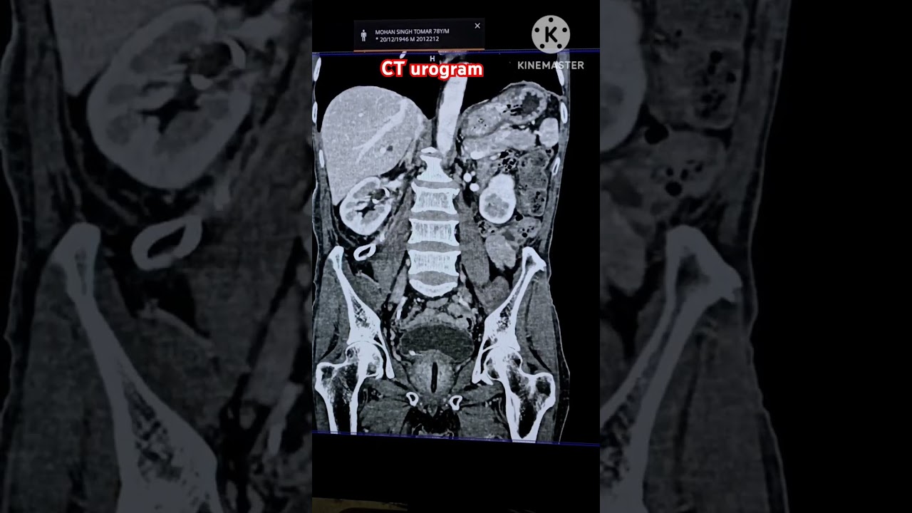 CT urogram #ctscan #currentaffairs #radio #radiology