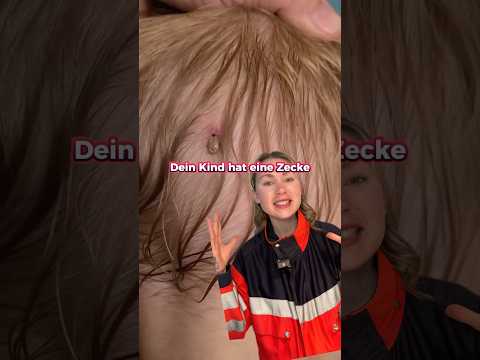 🚨Remove ticks CORRECTLY! #firstaid