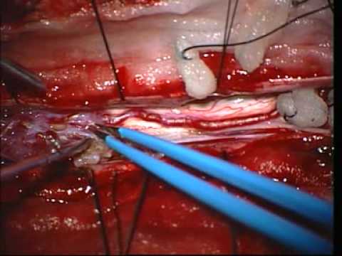 Malformacja tętniczo-żylna rdzenia kręgowego
