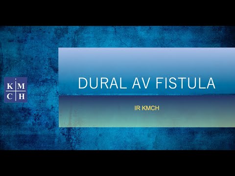 Dural AVF all the fundamentals you need to start treating DAVF .