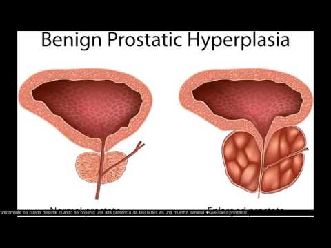 Prostatitis after catheterization