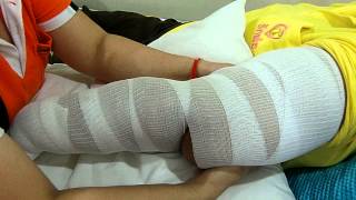 Twisting Tourniquet Technique for the lymphedema of the arm ขันชะเนาะลดบวมที่แขน