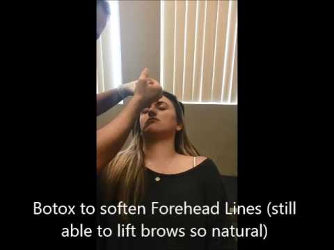 Botox to Remove Fine Lines and Eyebrow Lift Botox to Remove Fine Lines and Eyebrow Lift