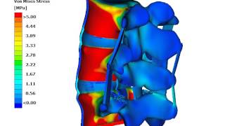 Facectomy in an L3-L5 lumbar spine segment