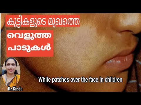 White patches over the face in children/കുട്ടികളുടെ മുഖത്തെ വെളുത്ത പാടുകൾ/parenting tips