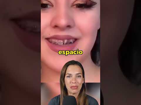 You'll want braces! - Before and after braces that will impress you