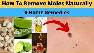 🙋‍♀️ How to Get Rid of Flat Moles? 8 Home Remedies