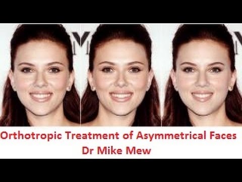 Orthotropics Treatment of Asymmetrical/ Disproportionate/ Uneven Faces by Dr MIke Mew