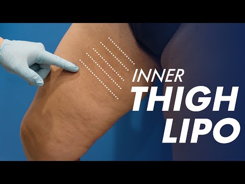 What to Expect From Liposuction in the Inner Thigh