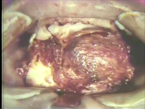 Removal of Large Ameloblastoma of Mandible