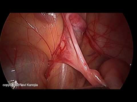 Laparoscopic Case Scenarios in Non Palpable Undescended Testis