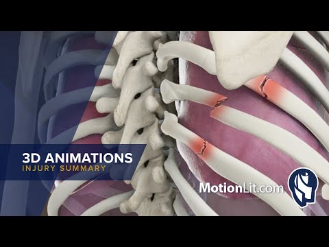 3D Animation Depicts Pneumothorax Injury In Police Abuse Case