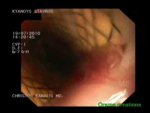 Stent In Esophagus - Replacement